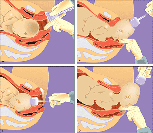 Normal Delivery vs C-Section: Benefits & Best Gynaecologist in Kolkata 4 Kolkata Best Gynaecologist Doctor
